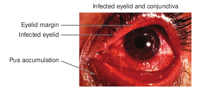 Infected eyelid and conjunctiva