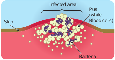 Bacterial infection on the skin