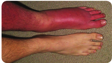 Cellulitis