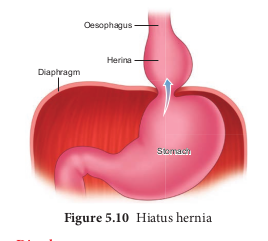 Hiatus hernia