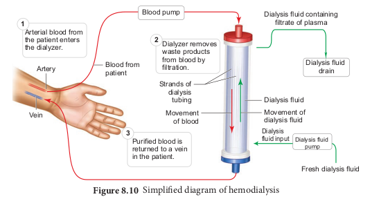 Simplified diagram of hemodialysis