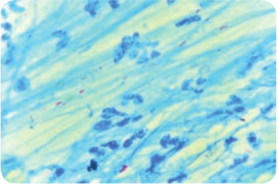  Acid fast staining of <em>Mycobacterium tuberculosis</em>