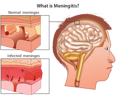  Pathogenesis of Meningitis