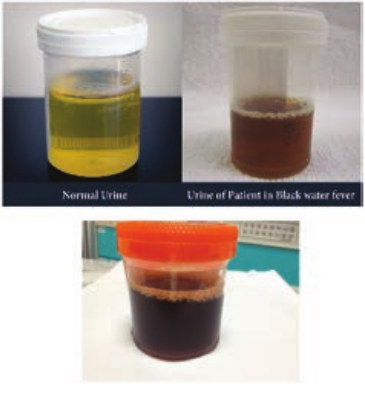  Urine in Black water Malaria  