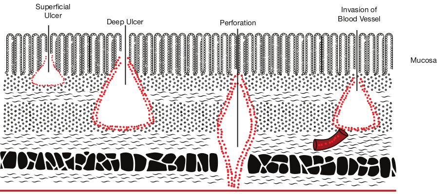  Ulcers in in