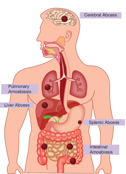  Extra-intestinal amoebiasis