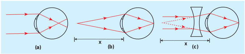 Myopic eye and correction