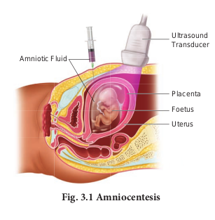 Fig. 3.1 Amniocentesis